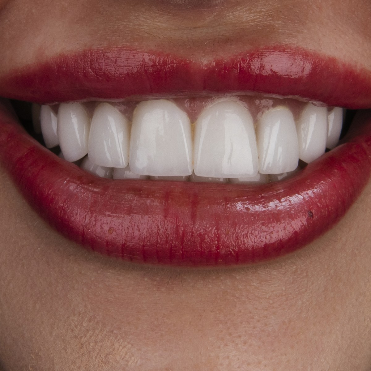 תקריב חיוך של מטופלת בקליניקת Fly & Smile
