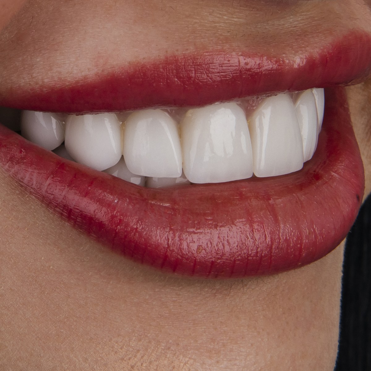 תקריב חיוך של מטופלת בקליניקת Fly & Smile