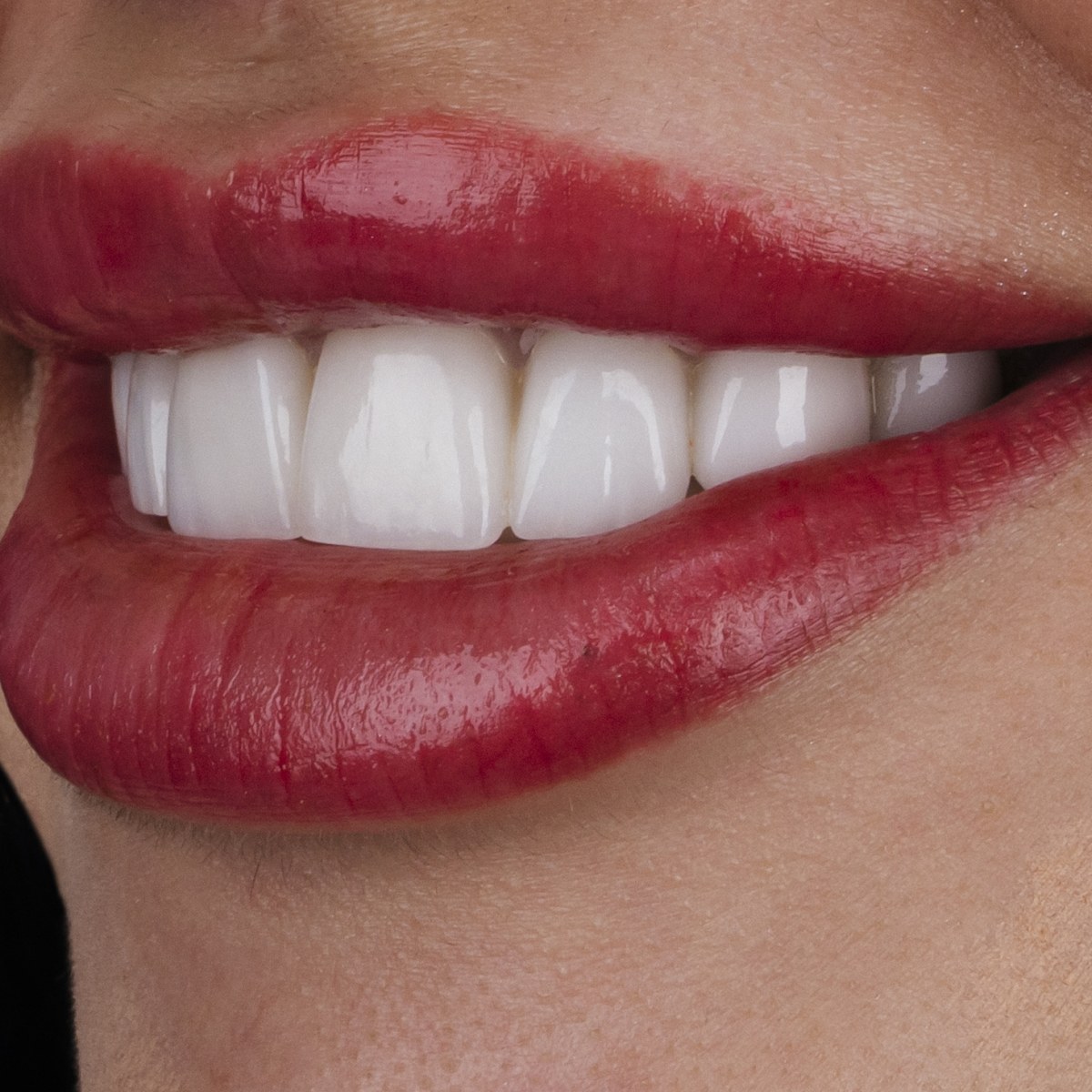 תקריב חיוך של מטופלת בקליניקת Fly & Smile