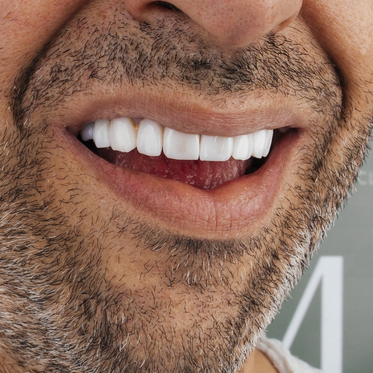 תקריב חיוך של מטופל בקליניקת Fly & Smile