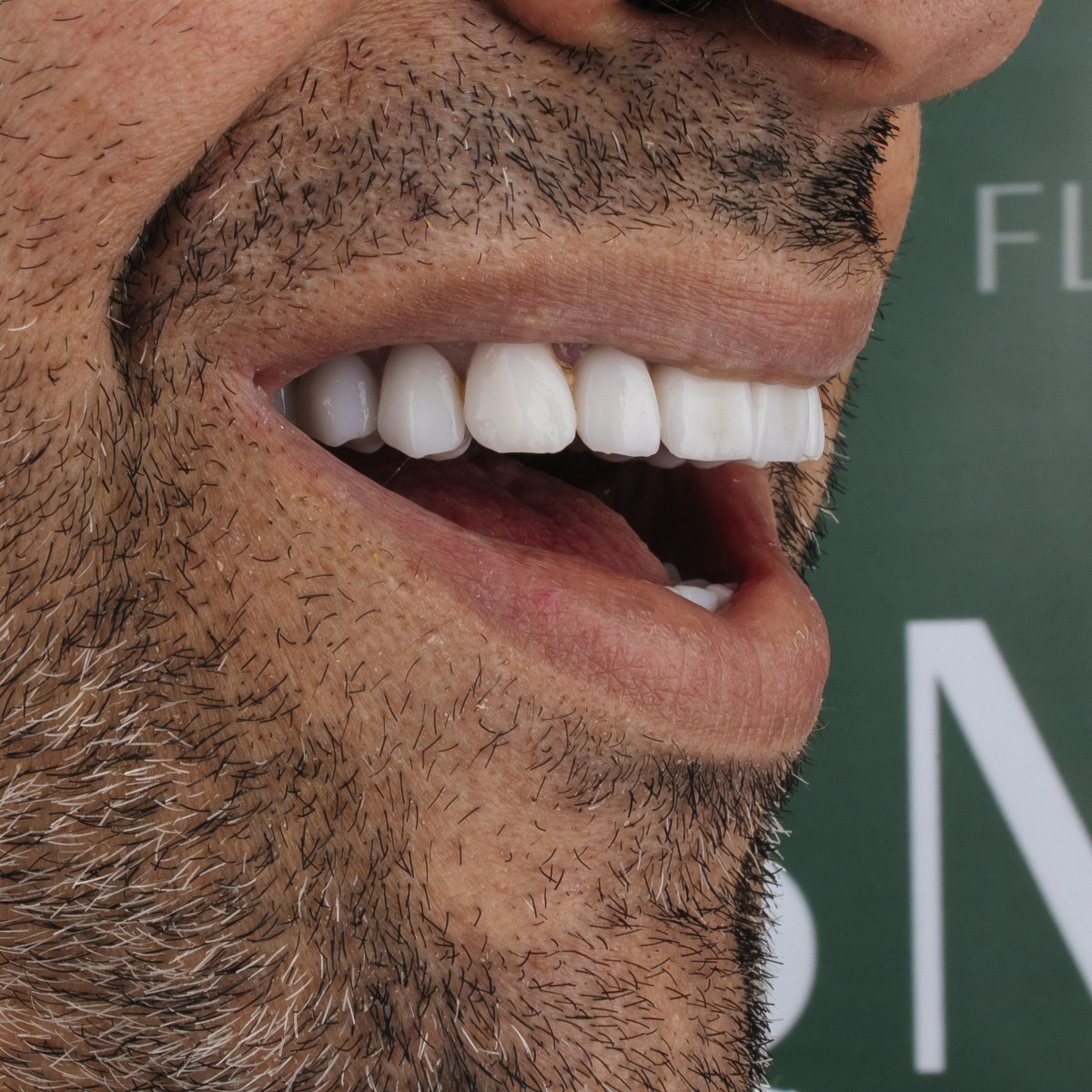 תקריב חיוך של מטופל בקליניקת Fly & Smile