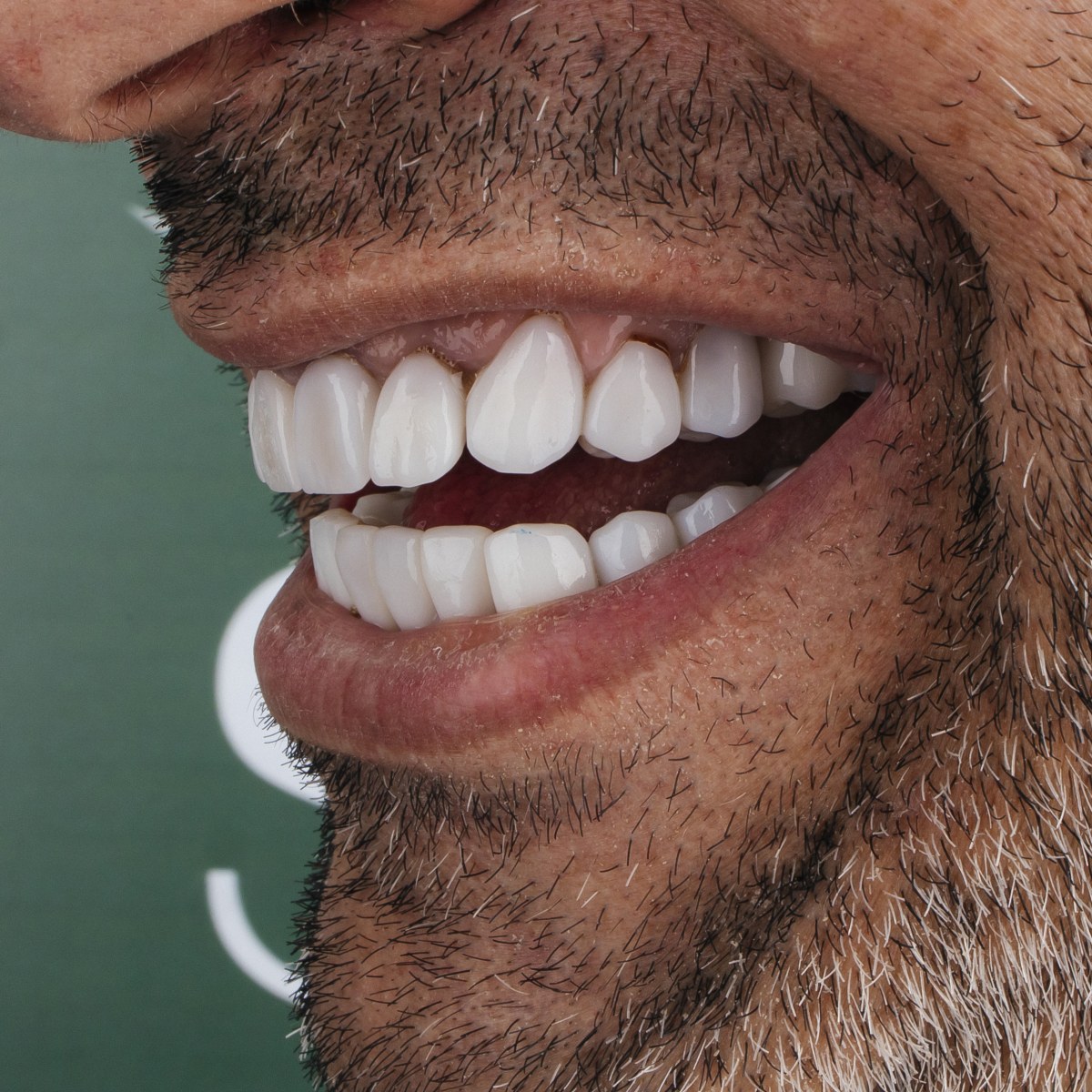 תקריב חיוך של מטופל בקליניקת Fly & Smile