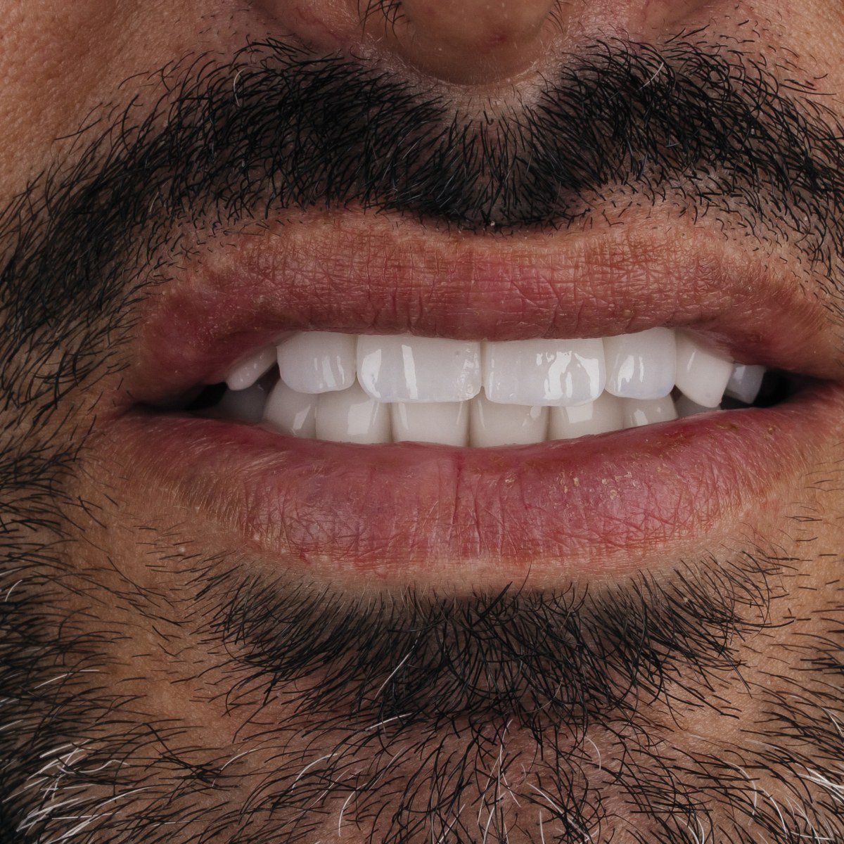 תקריב חיוך של מטופל בקליניקת Fly & Smile
