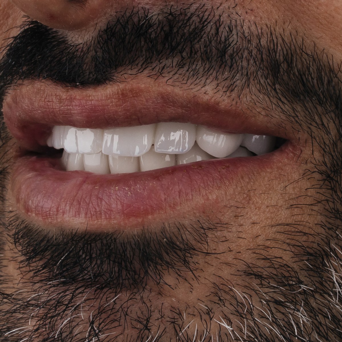 תקריב חיוך של מטופל בקליניקת Fly & Smile