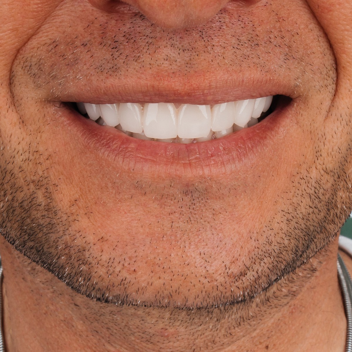 תקריב חיוך של מטופלת בקליניקת Fly & Smile
