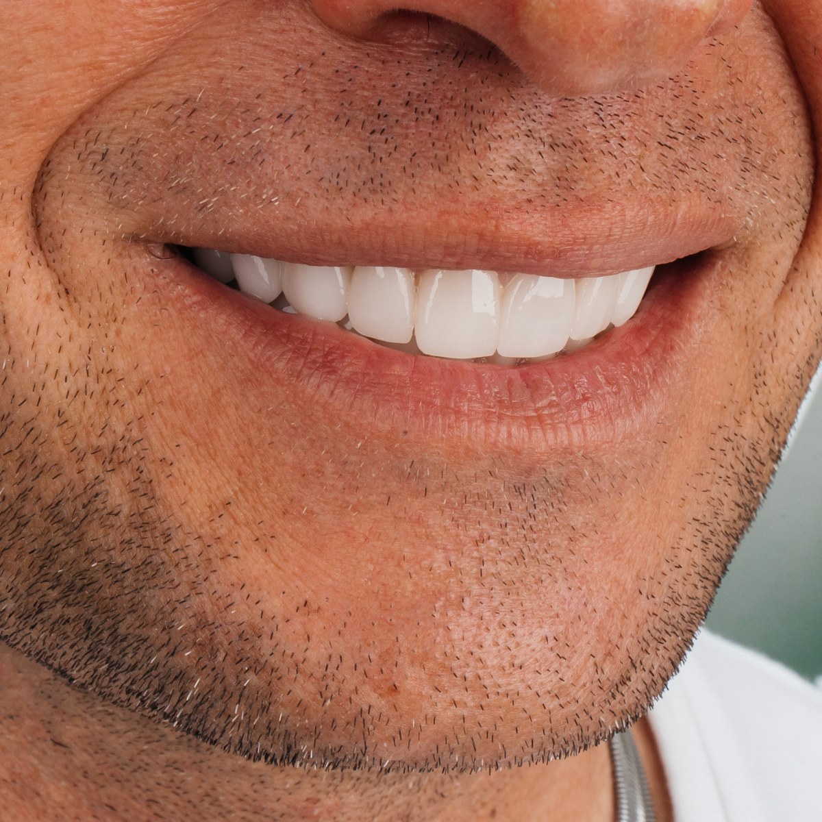 תקריב חיוך של מטופלת בקליניקת Fly & Smile