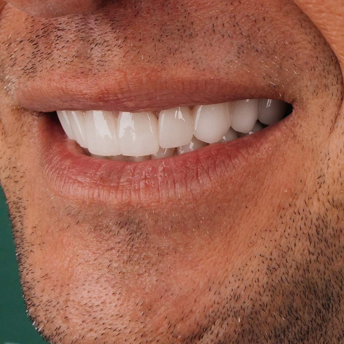 תקריב חיוך של מטופלת בקליניקת Fly & Smile