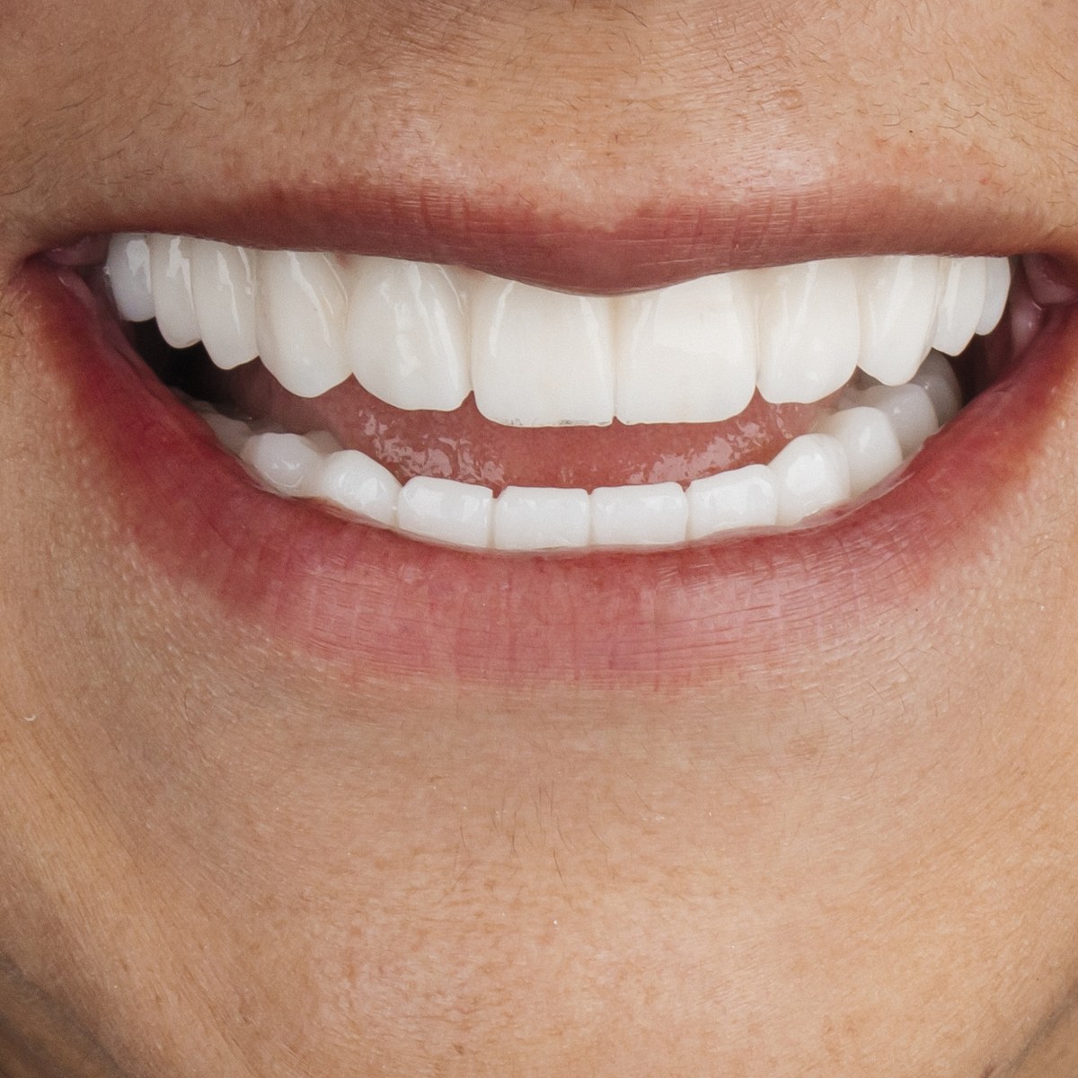 תקריב חיוך של מטופלת בקליניקת Fly & Smile
