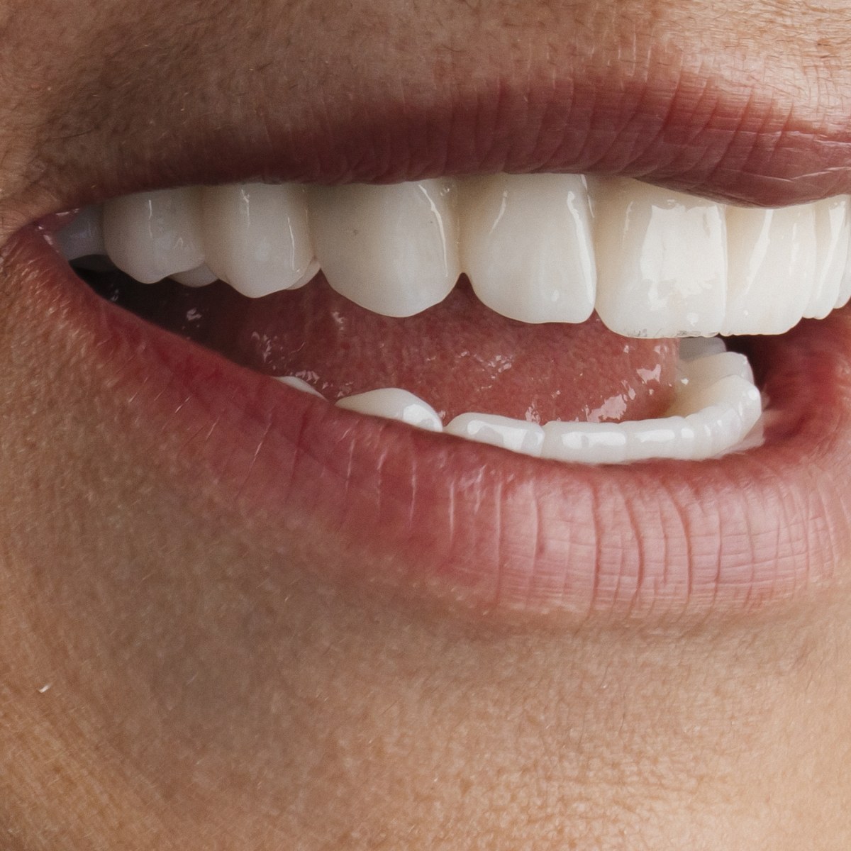 תקריב חיוך של מטופלת בקליניקת Fly & Smile