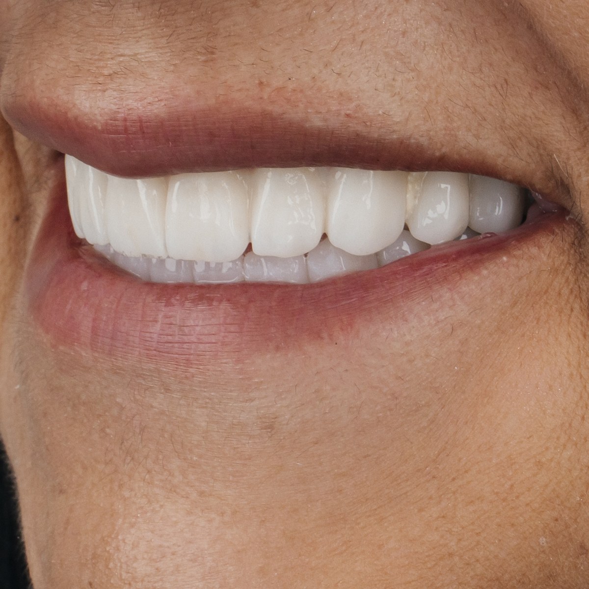 תקריב חיוך של מטופלת בקליניקת Fly & Smile