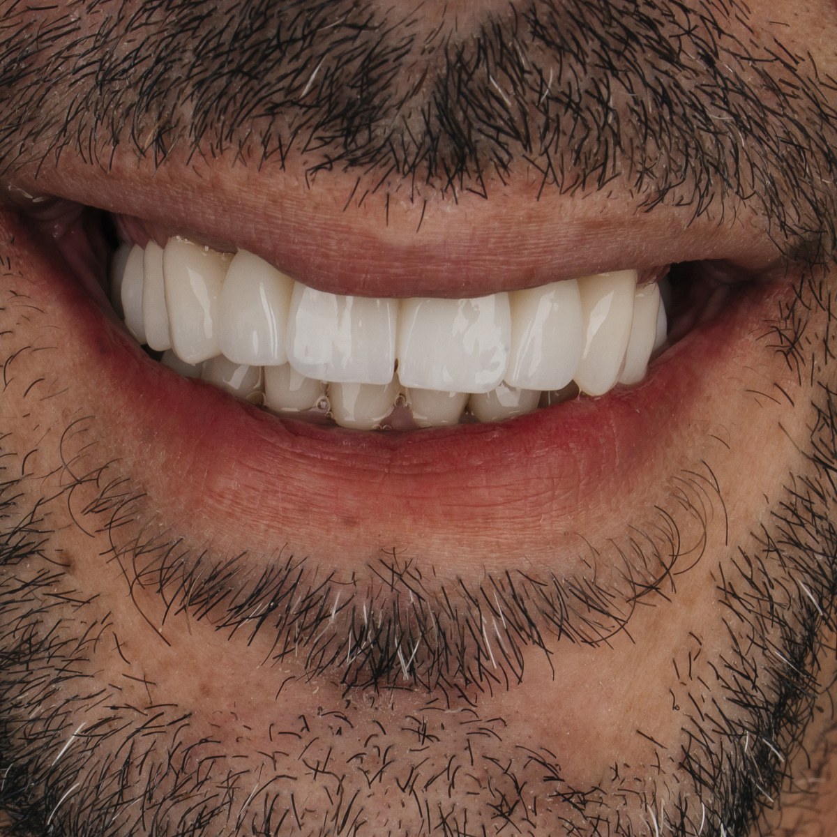 תקריב חיוך של מטופל בקליניקת Fly & Smile