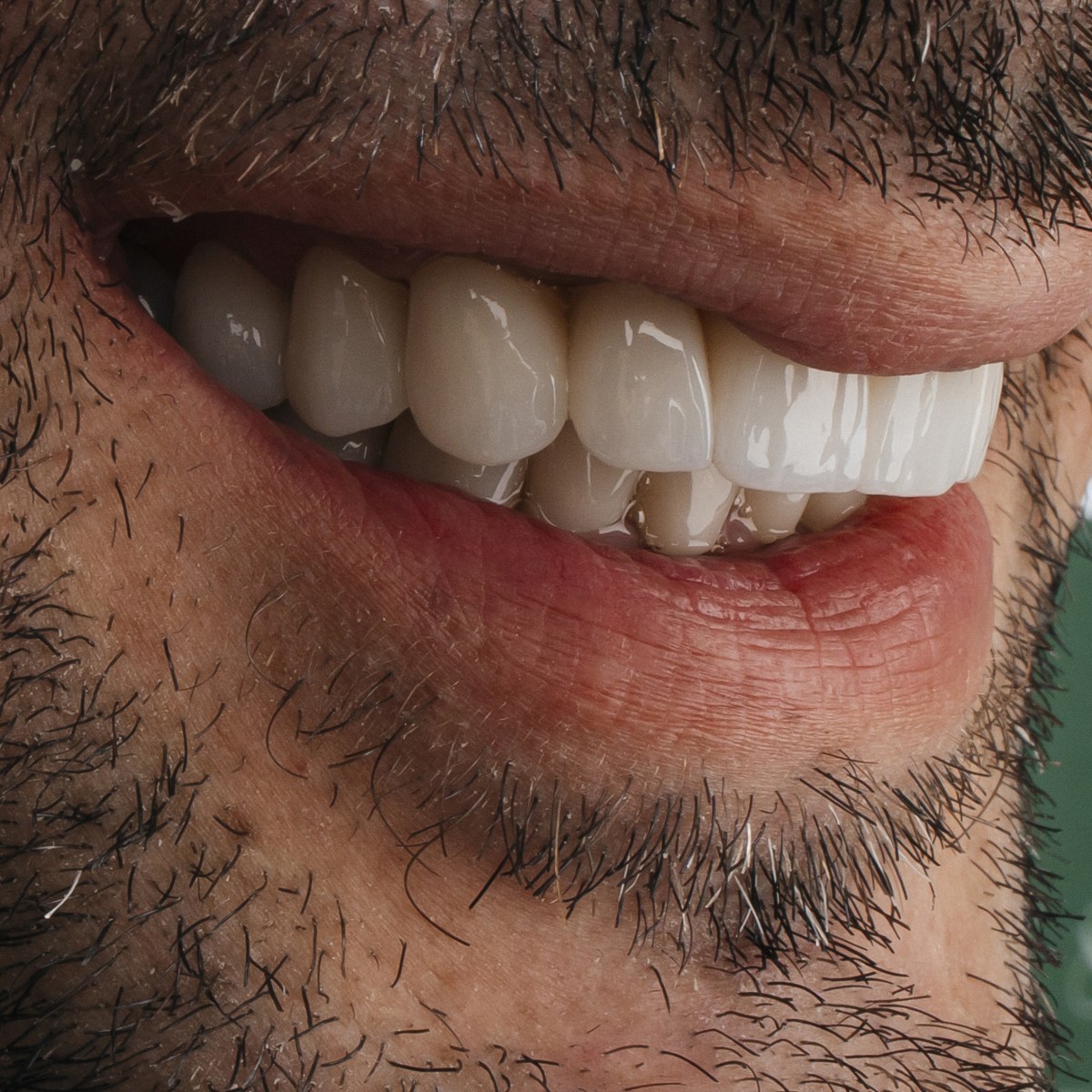 תקריב חיוך של מטופל בקליניקת Fly & Smile
