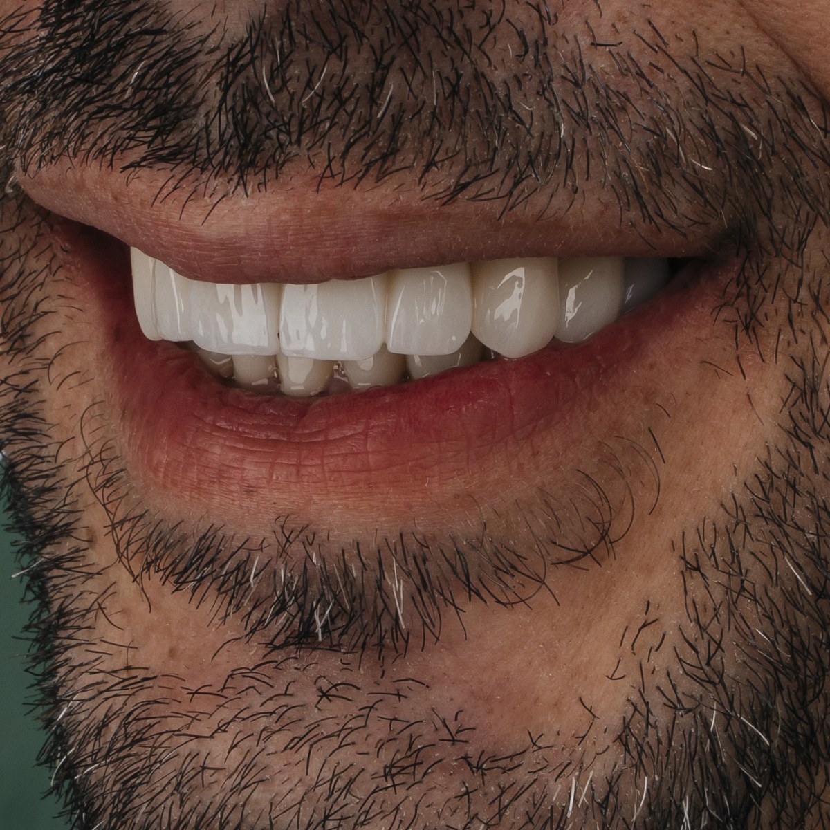 תקריב חיוך של מטופל בקליניקת Fly & Smile