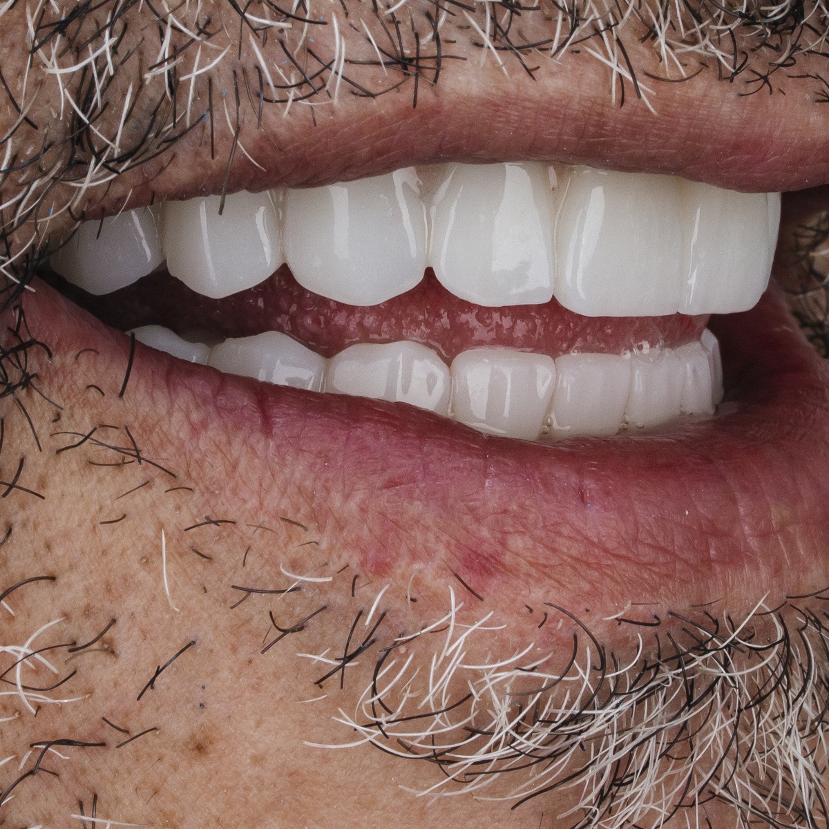 תקריב חיוך של מטופלת בקליניקת Fly & Smile