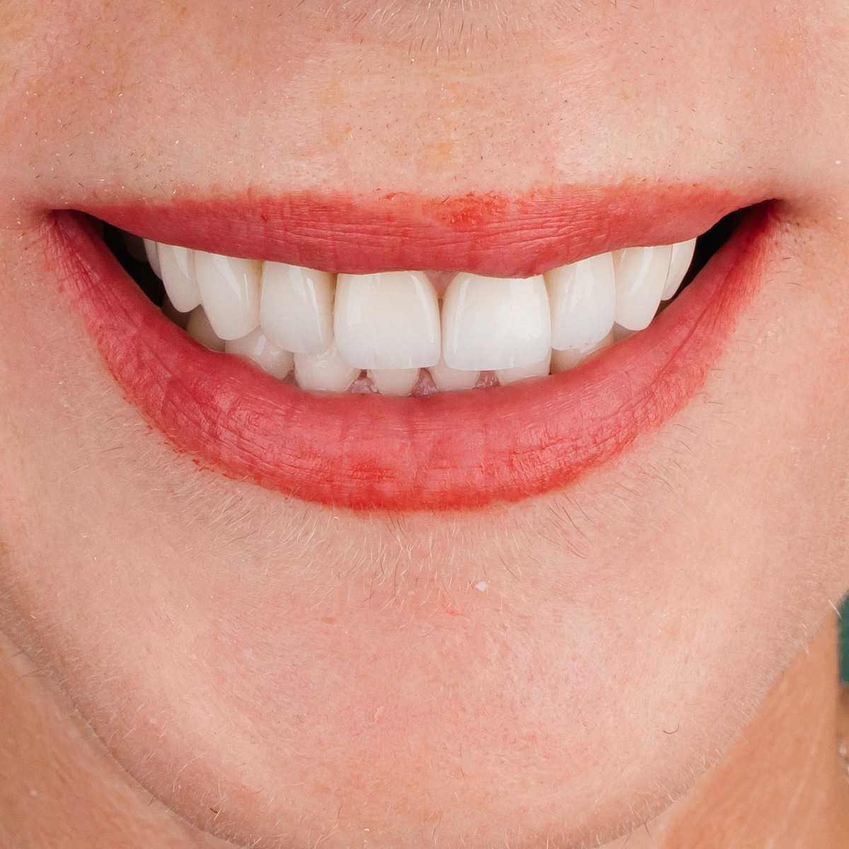 תקריב חיוך של מטופלת בקליניקת Fly & Smile