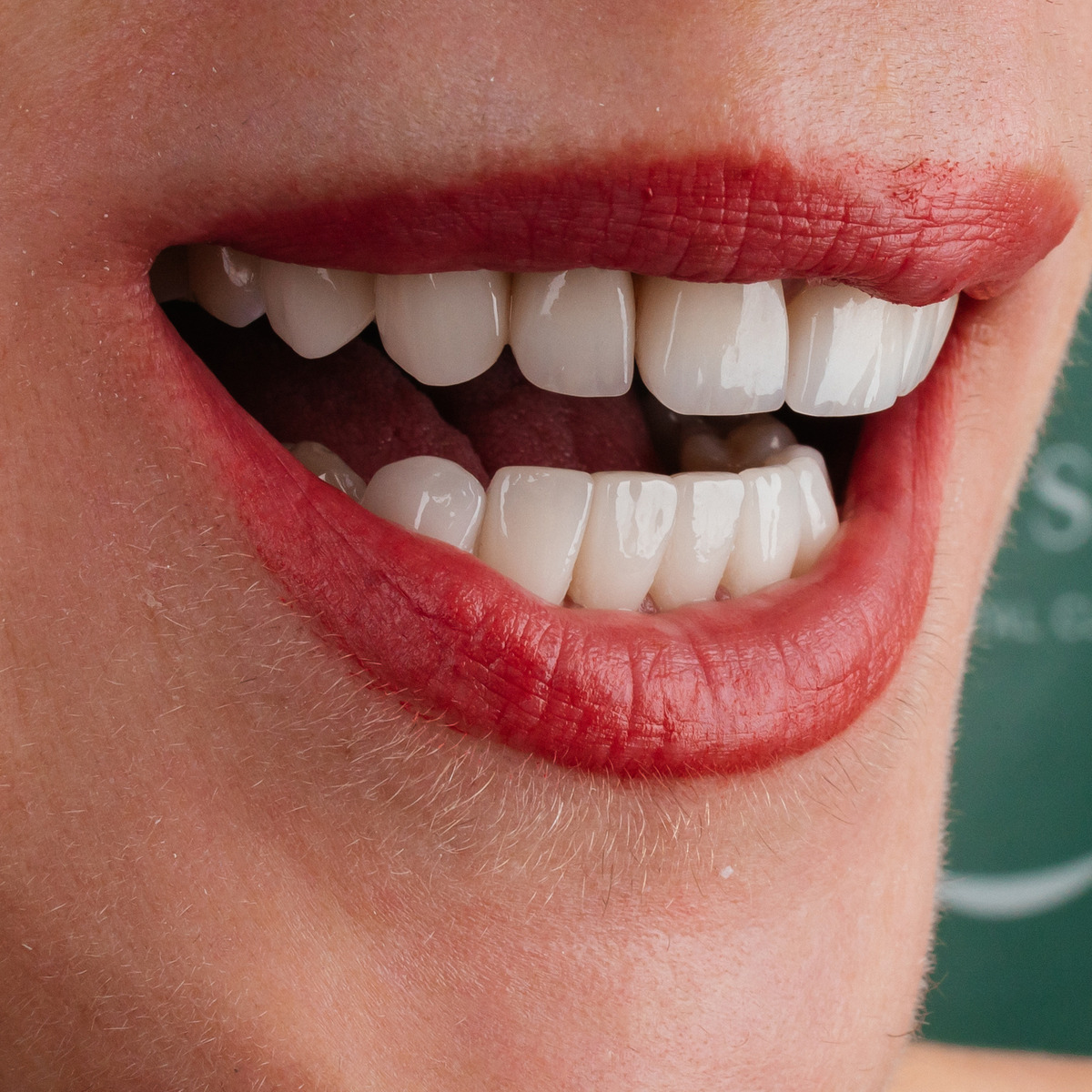 תקריב חיוך של מטופלת בקליניקת Fly & Smile