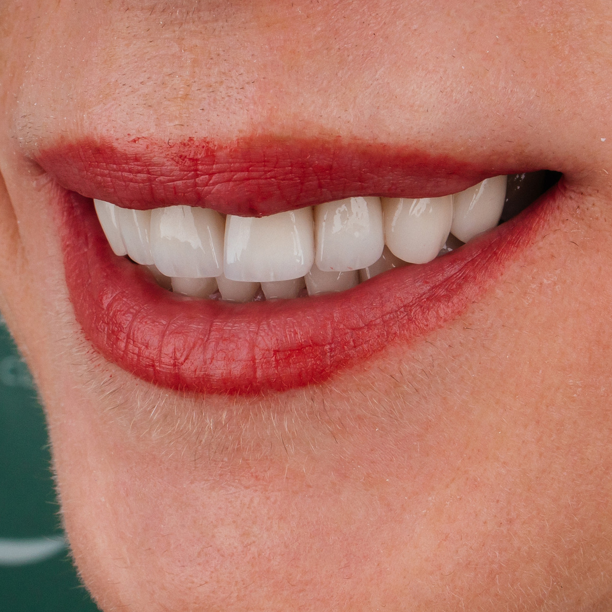 תקריב חיוך של מטופלת בקליניקת Fly & Smile