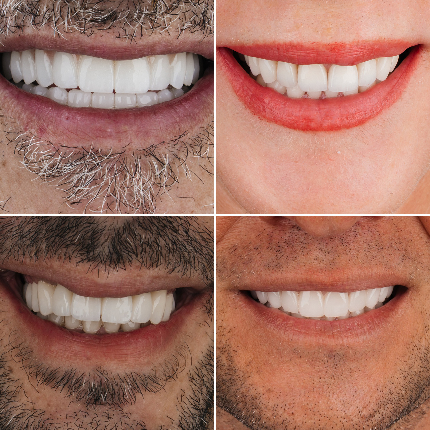 תקריבי חיוך של מטופלים בקליניקת Fly & Smile